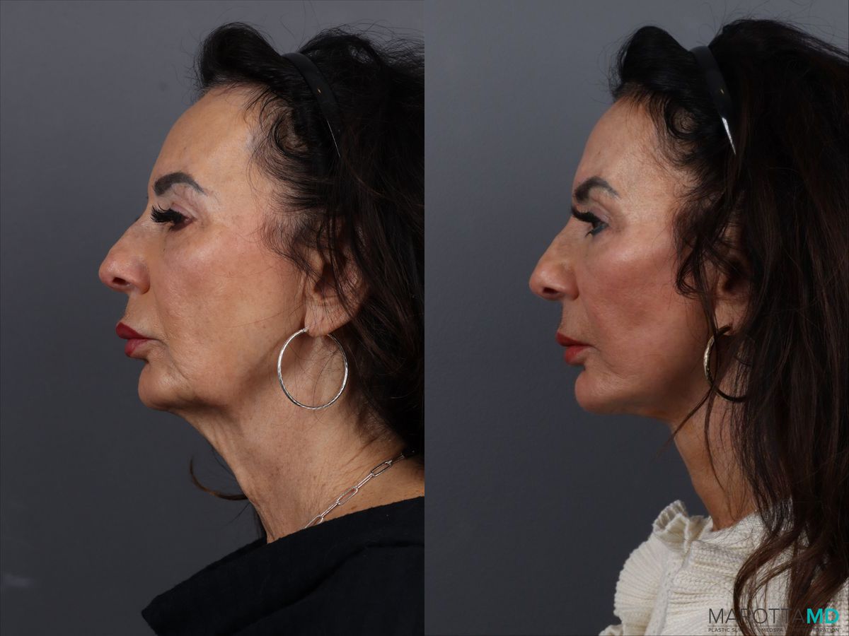 Before and after Facelift & Neck Lift case 12922 - Angle 5