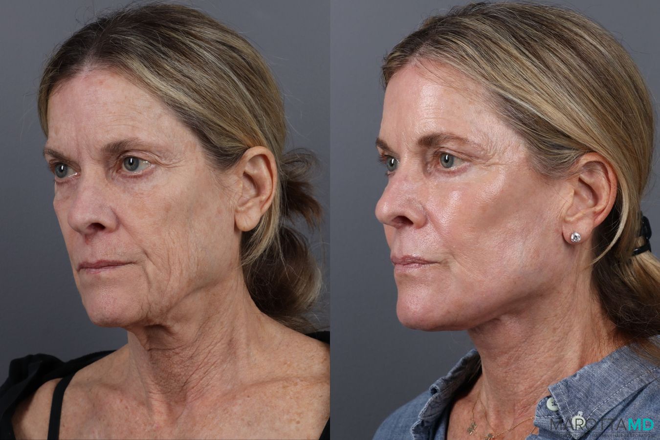 Before and after Blepharoplasty Lower case 19695 - Angle 4
