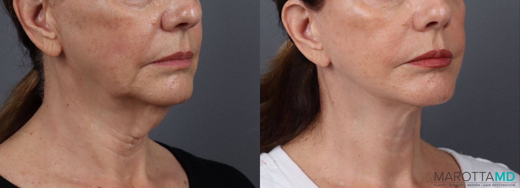 Before and after Facelift & Neck Lift case 19692 - Angle 2