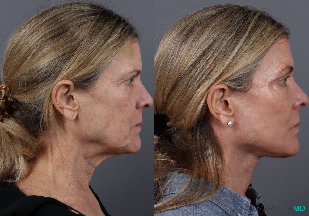 Fat Transfer - Face - Thumbnail 3