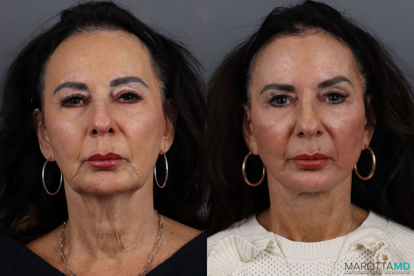 Before and after Facelift & Neck Lift case 12922