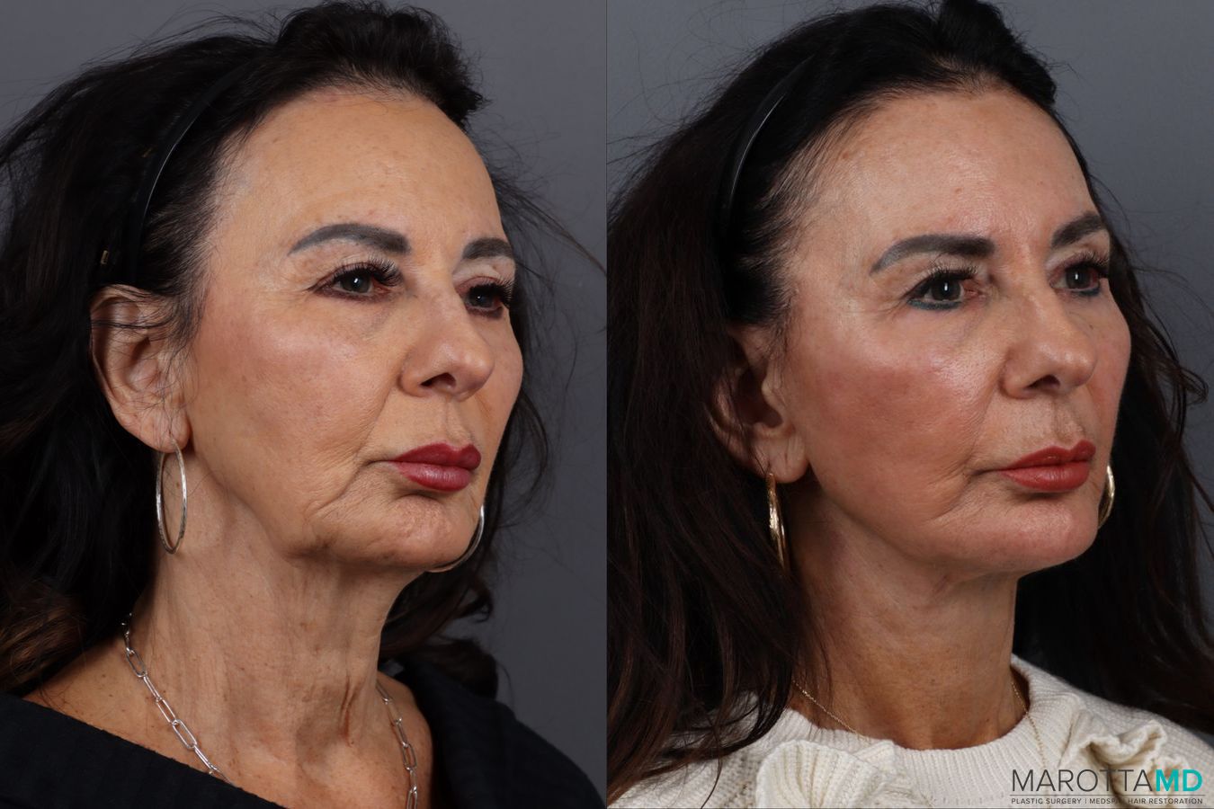 Before and after Facelift & Neck Lift case 12922 - Angle 2