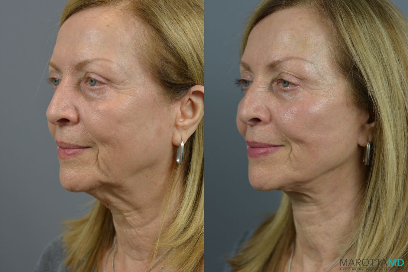 Before and after Facelift & Neck Lift case 21668 - Angle 2