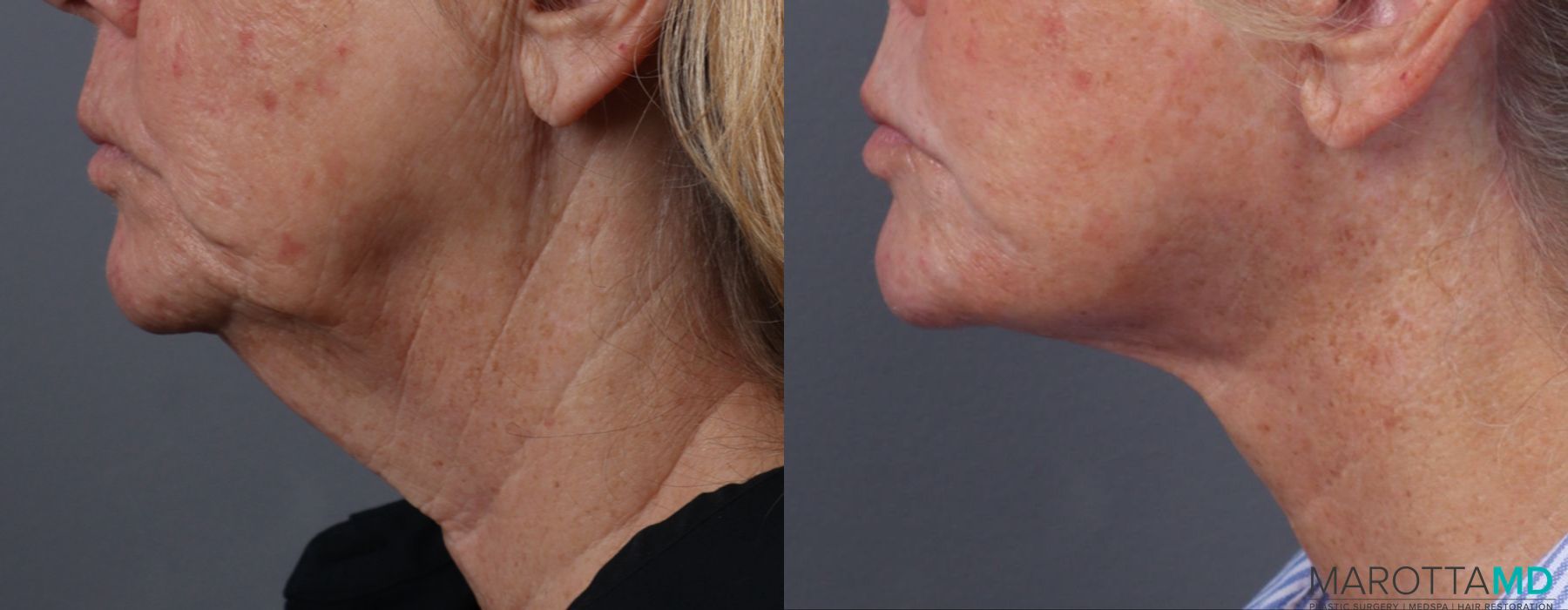 Facelift & Neck Lift - Thumbnail 5