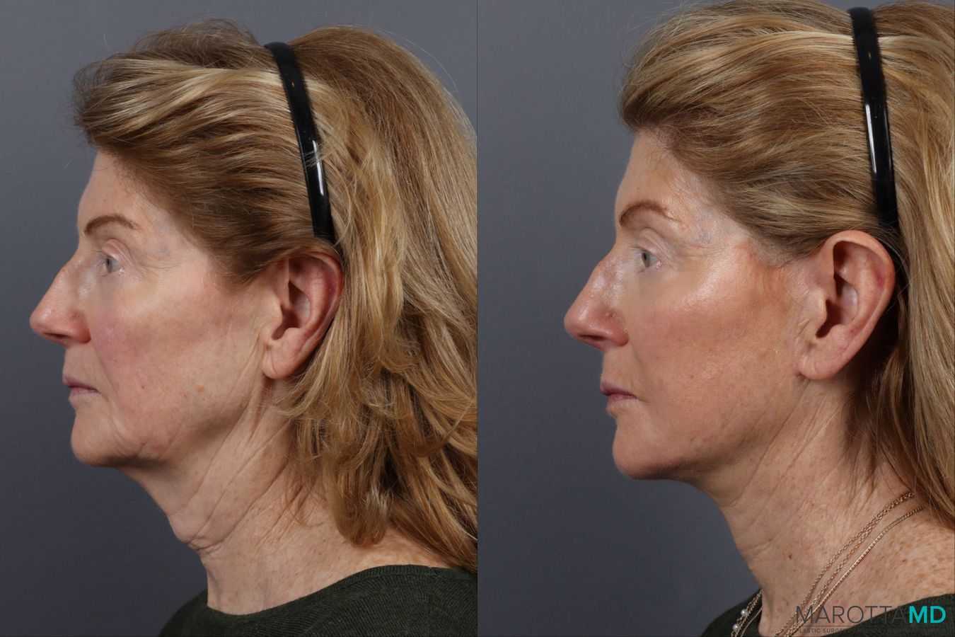 Before and after Facelift & Neck Lift case 12827 - Angle 5