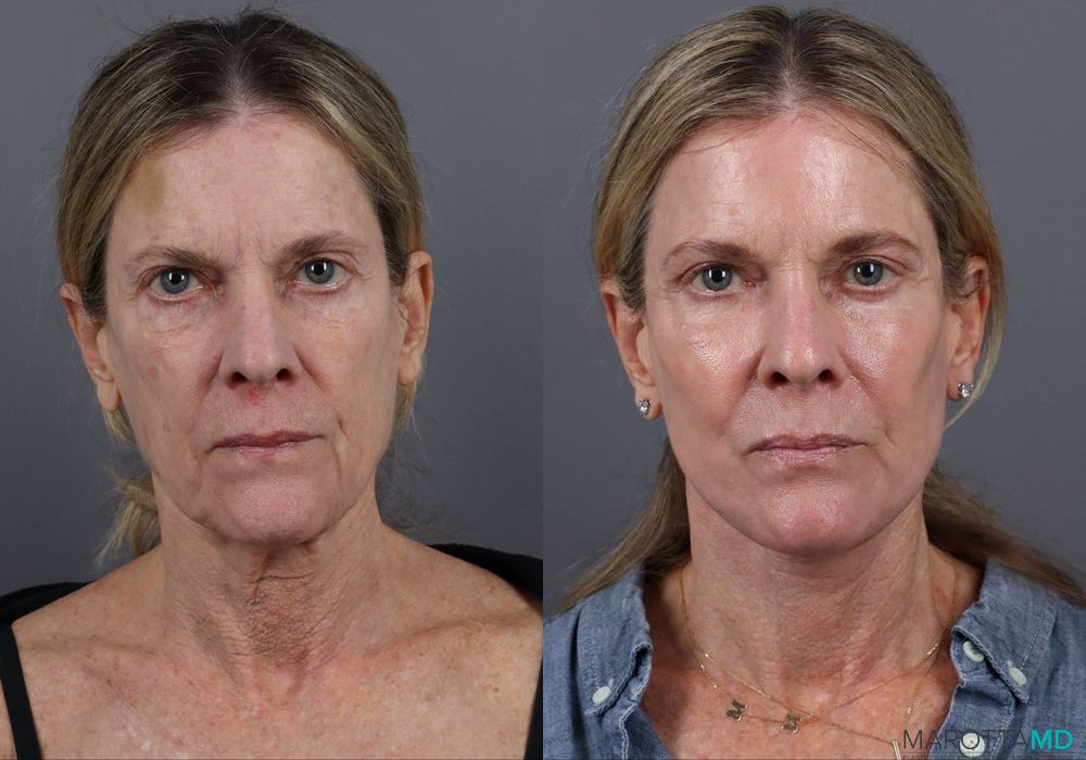 Blepharoplasty Lower - Case 165