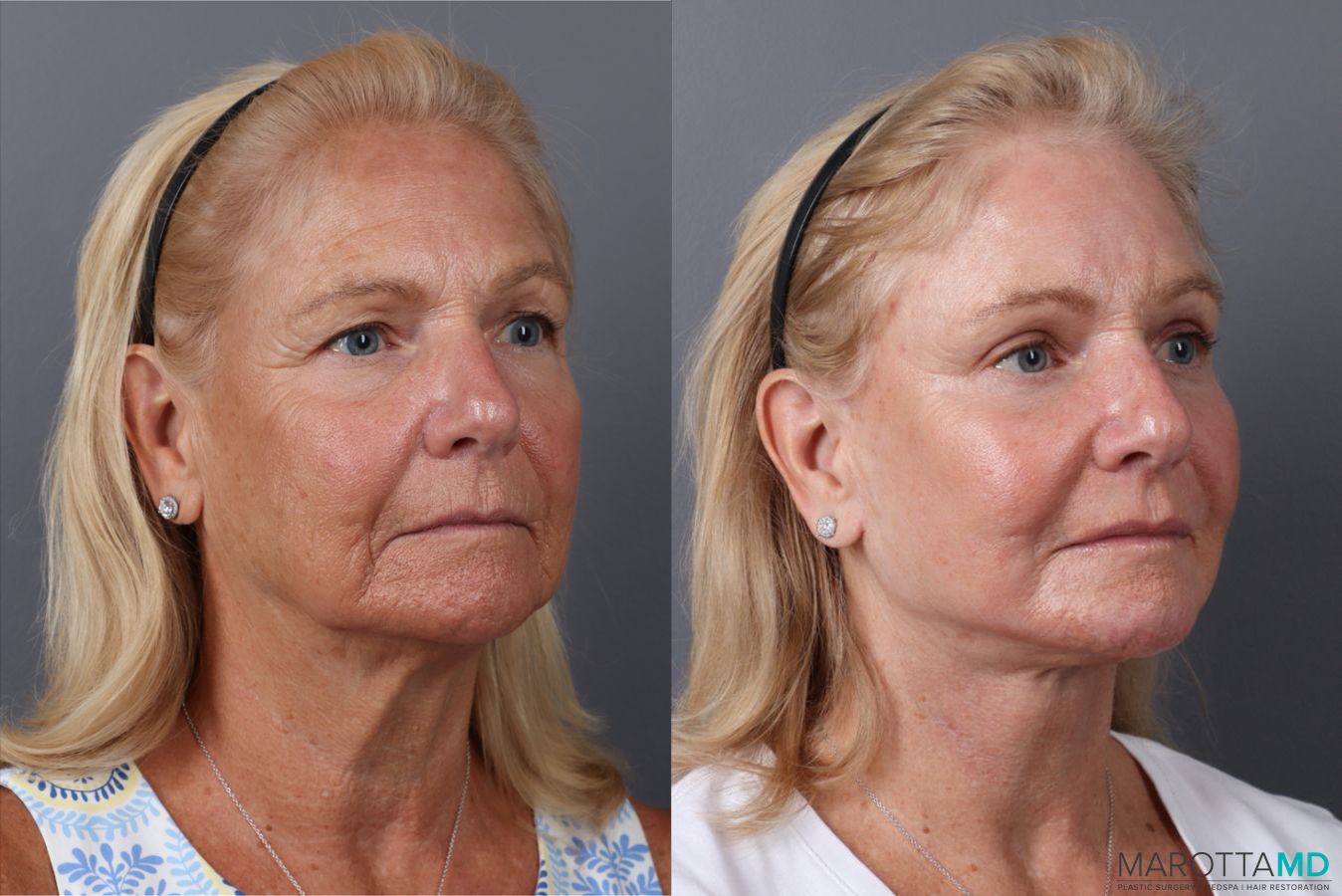 Before and after Laser Skin Resurfacing case 43233 - Angle 2