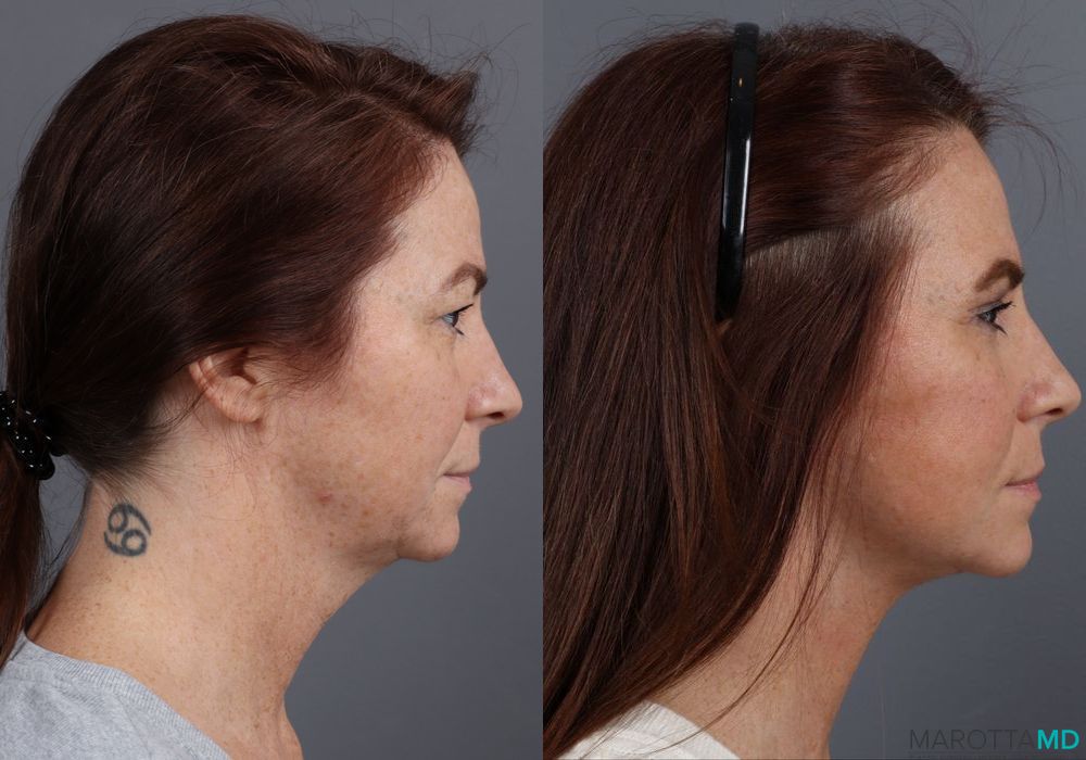 Before and after Facelift & Neck Lift case 12316 - Angle 3
