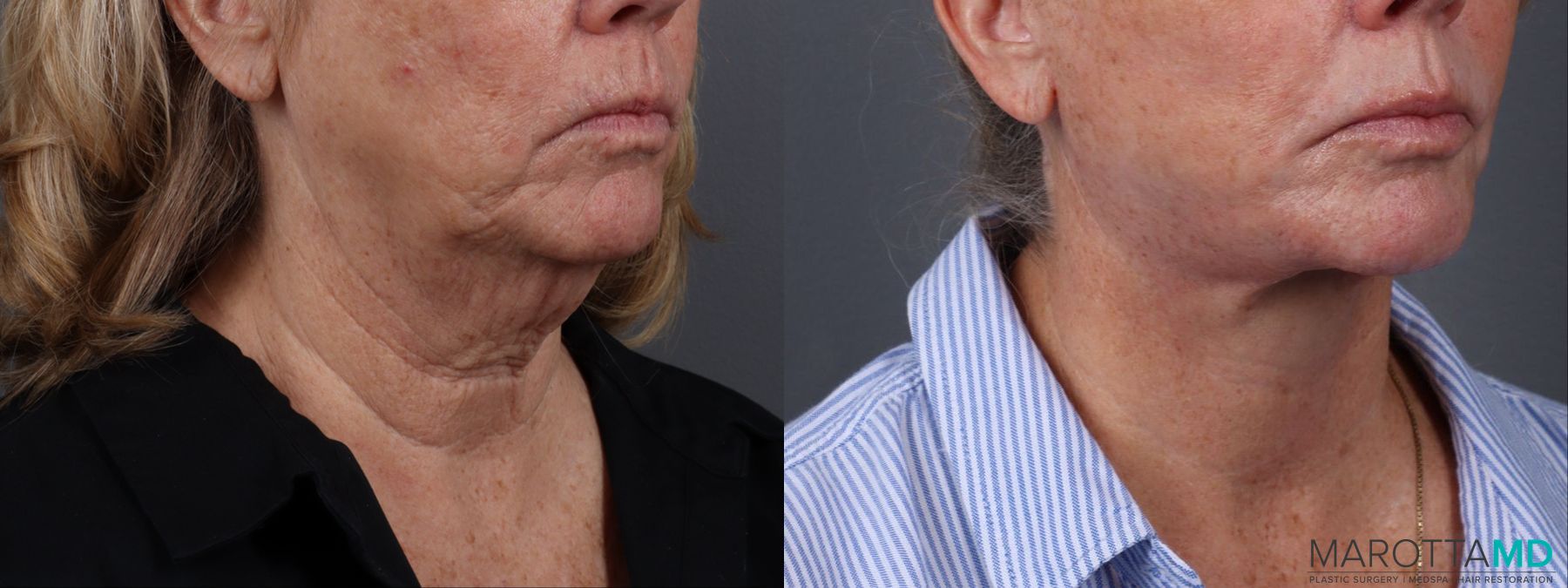 Before and after Fat Transfer - Face case 23768 - Angle 2