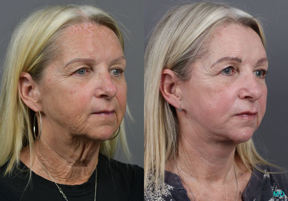 Facelift & Neck Lift - Thumbnail 2