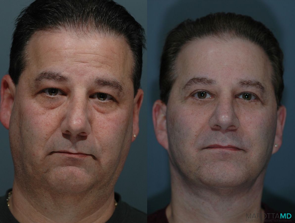 Before and after Facelift & Neck Lift case 7108