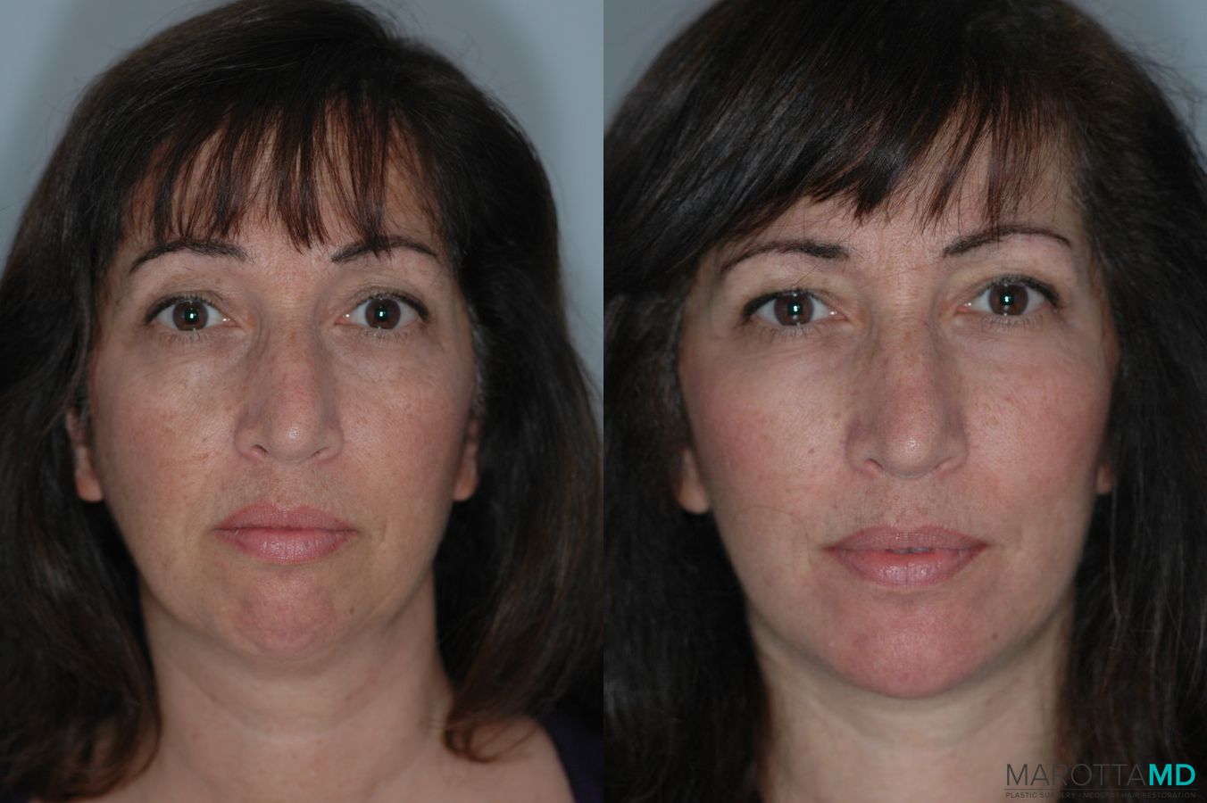 Before and after Facelift & Neck Lift case 7098