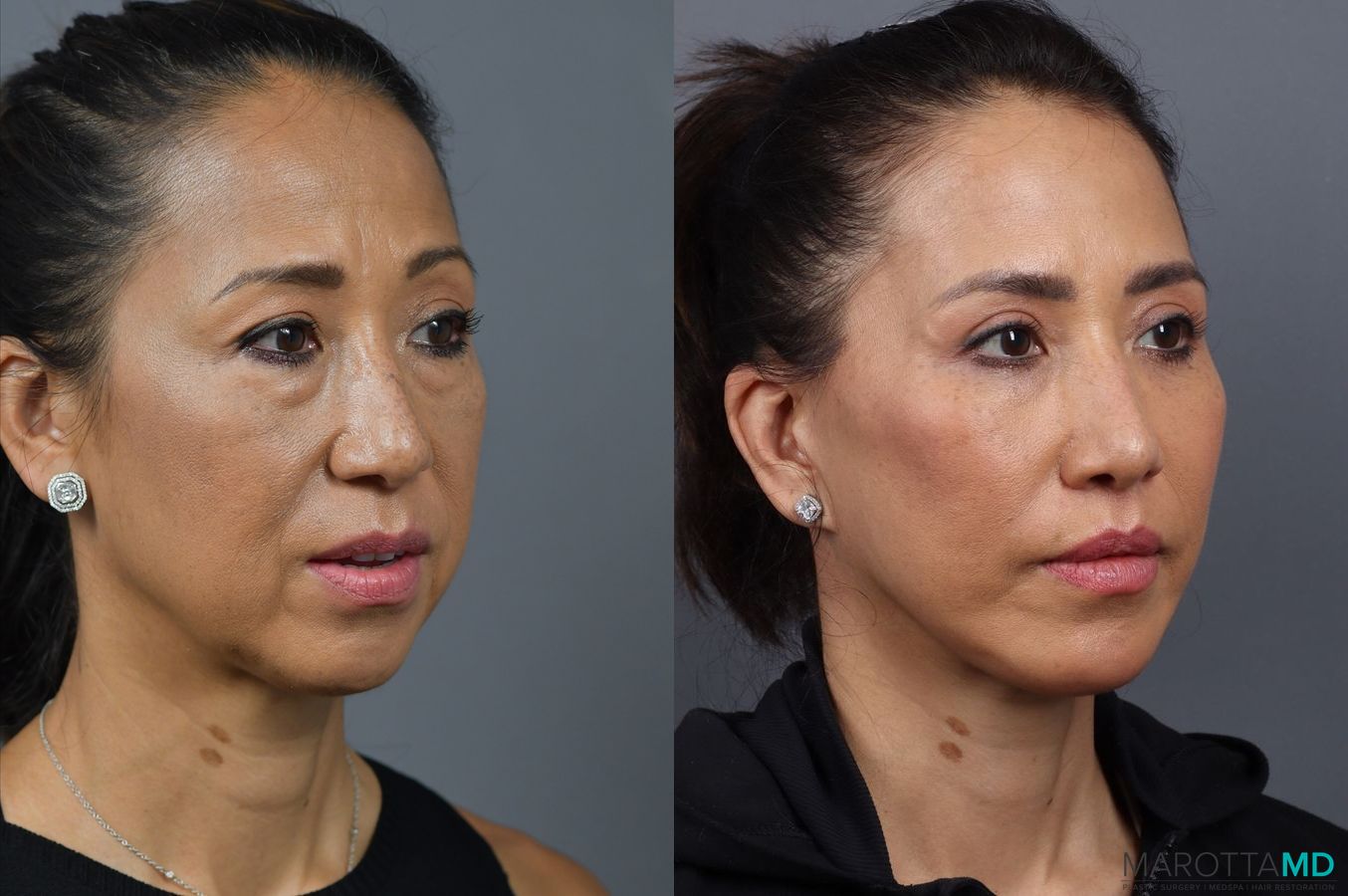 Before and after Facelift/Mini Facelift case 7000 - Angle 2