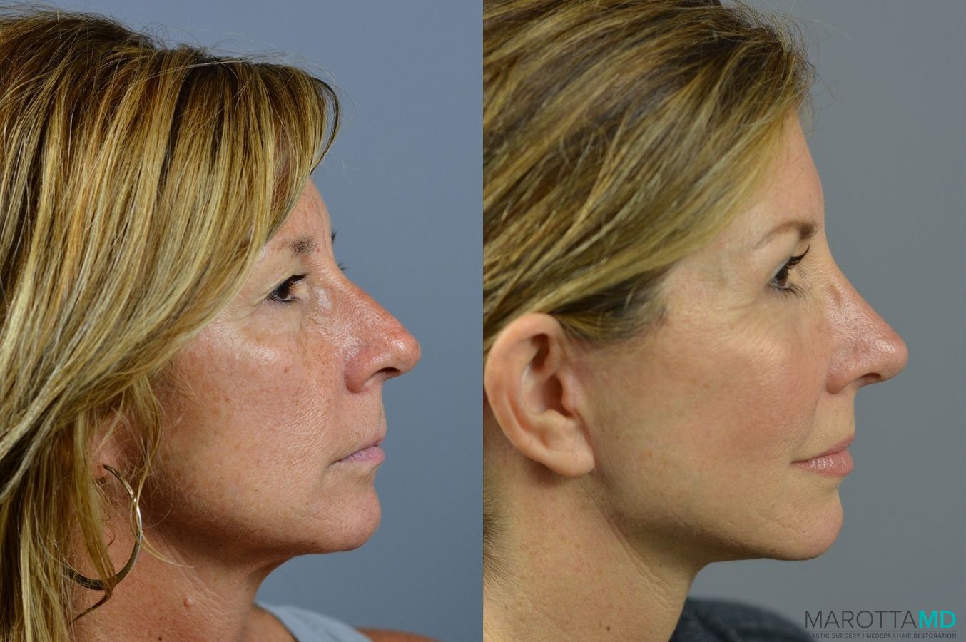 Before and after Fat Transfer - Face case 7255 - Angle 3