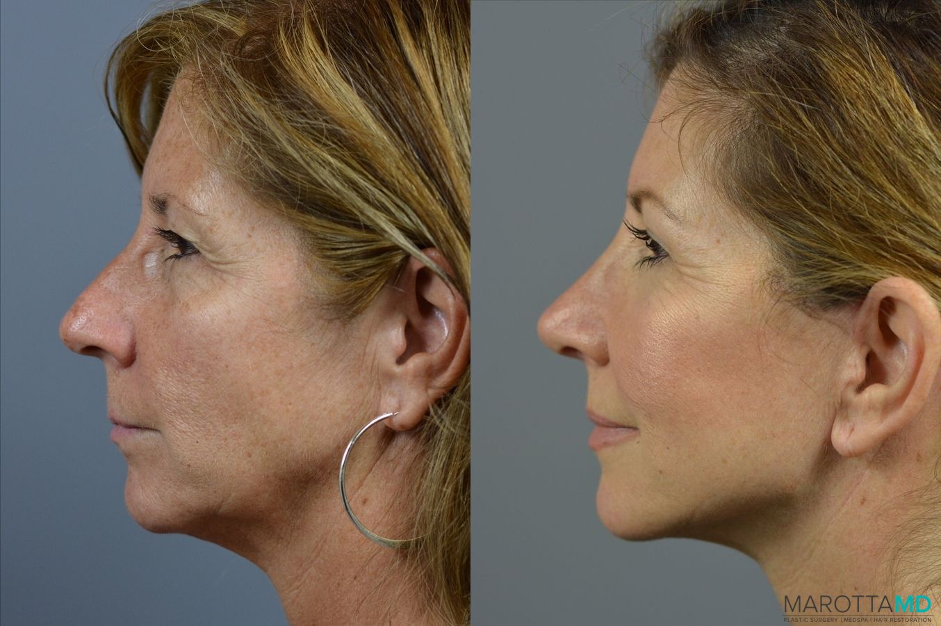Before and after Fat Transfer - Face case 7255 - Angle 5