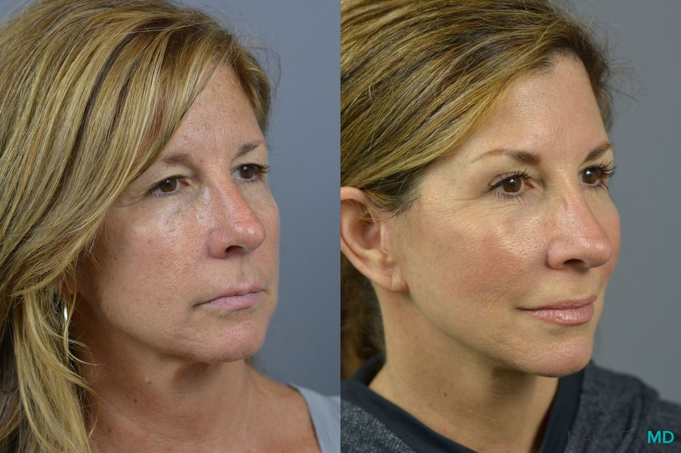 Before and after Fat Transfer - Face case 7255 - Angle 2