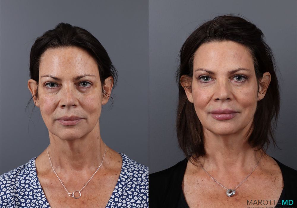 Botox - DAO - Case 221