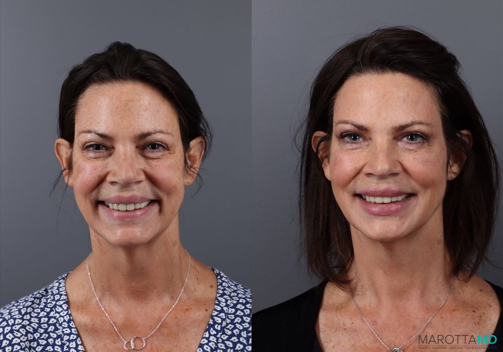 Botox - Nefertiti Neck Lift - Thumbnail 2