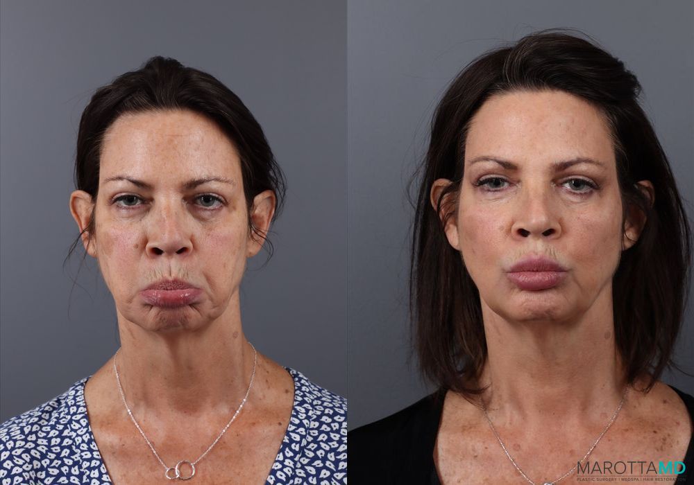 Botox - Nefertiti Neck Lift - Thumbnail 4