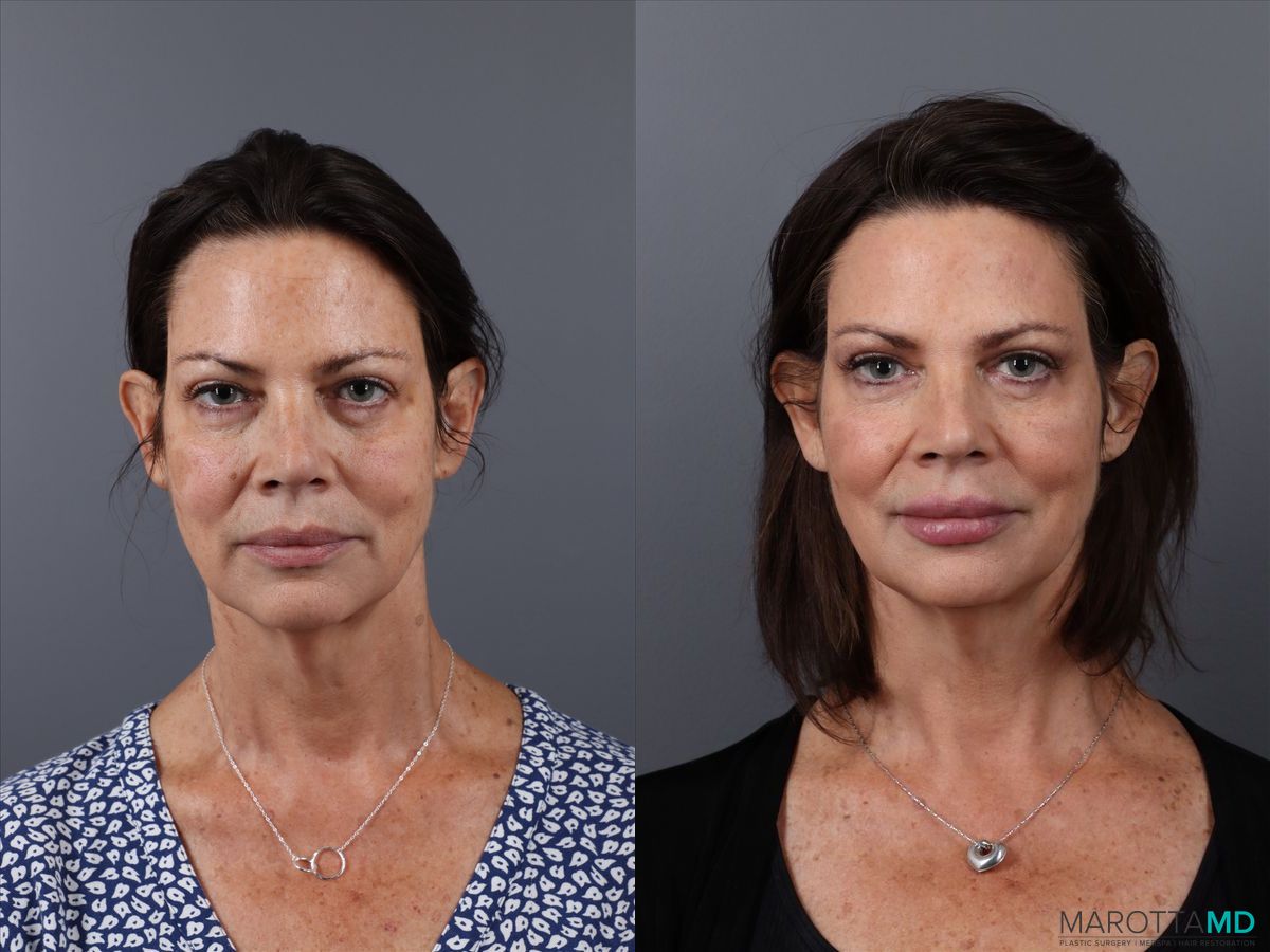 Before and after Botox - DAO case 21525