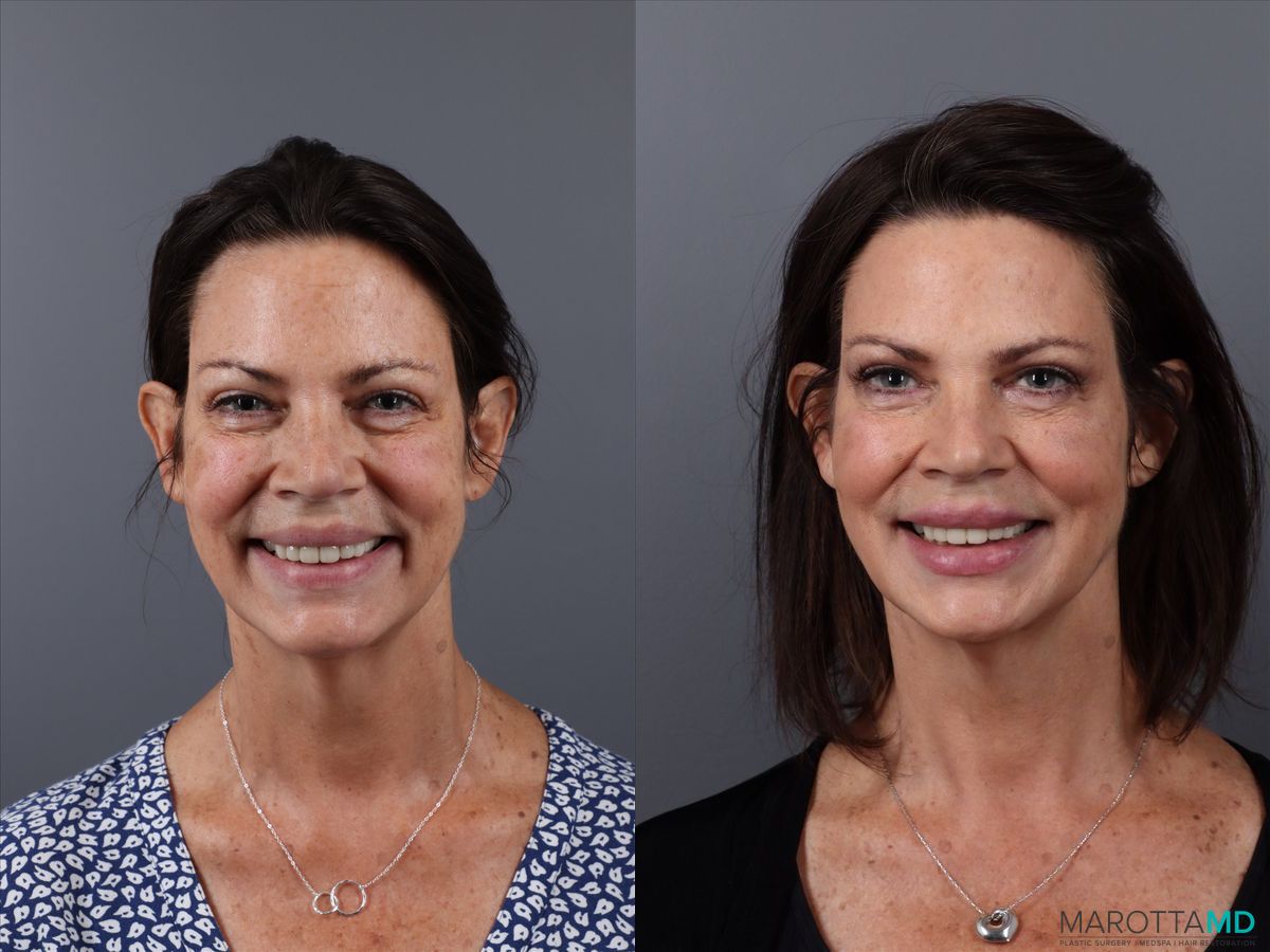 Before and after Botox - DAO case 21525 - Angle 2