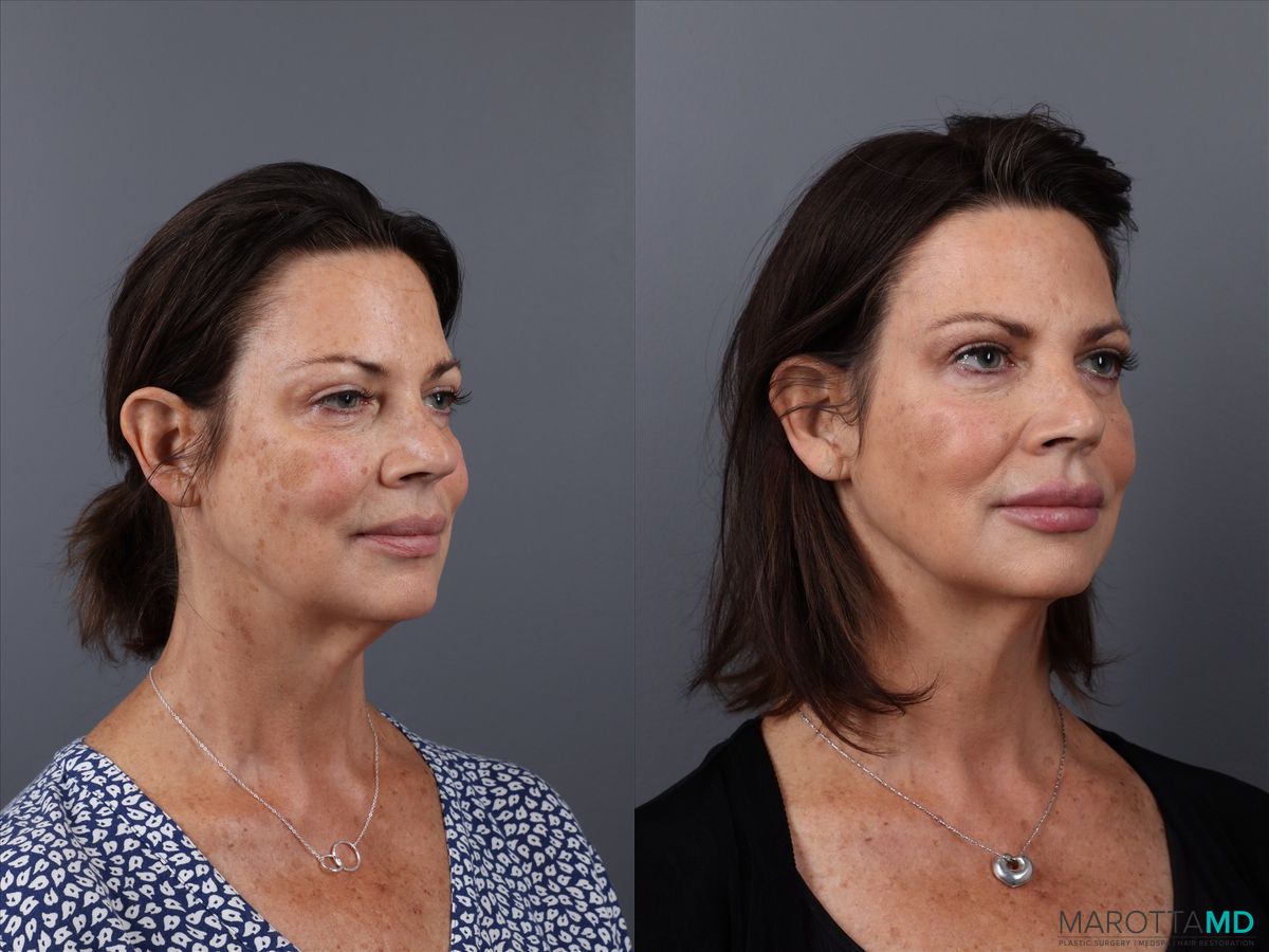 Before and after Botox - DAO case 21525 - Angle 3