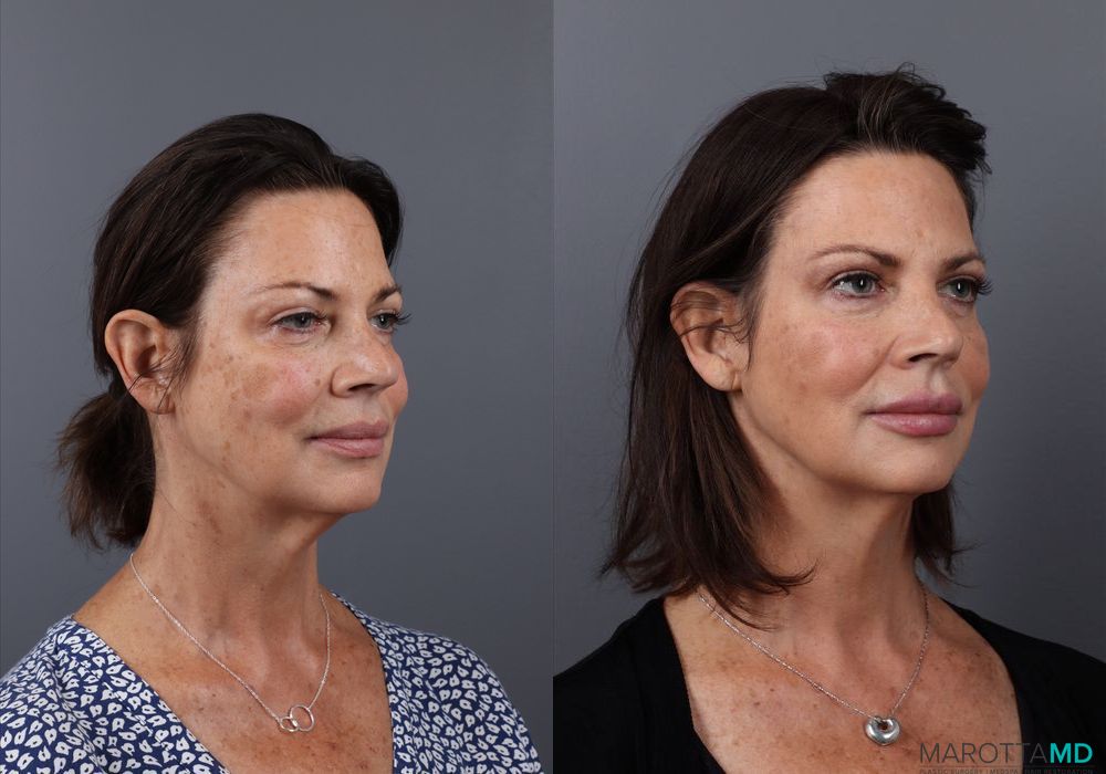 Botox - DAO - Thumbnail 3