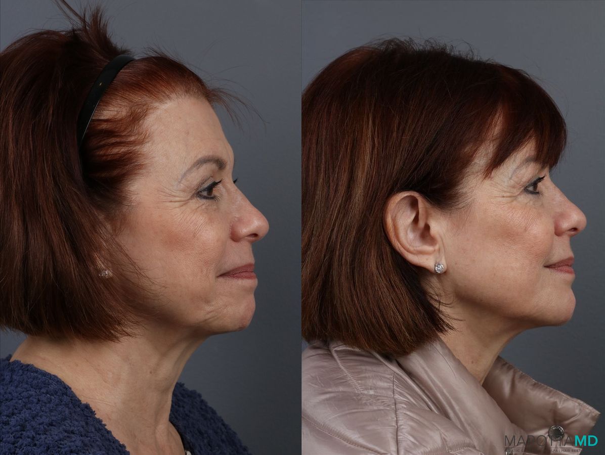 Before and after Filler - Cheek case 7316 - Angle 4