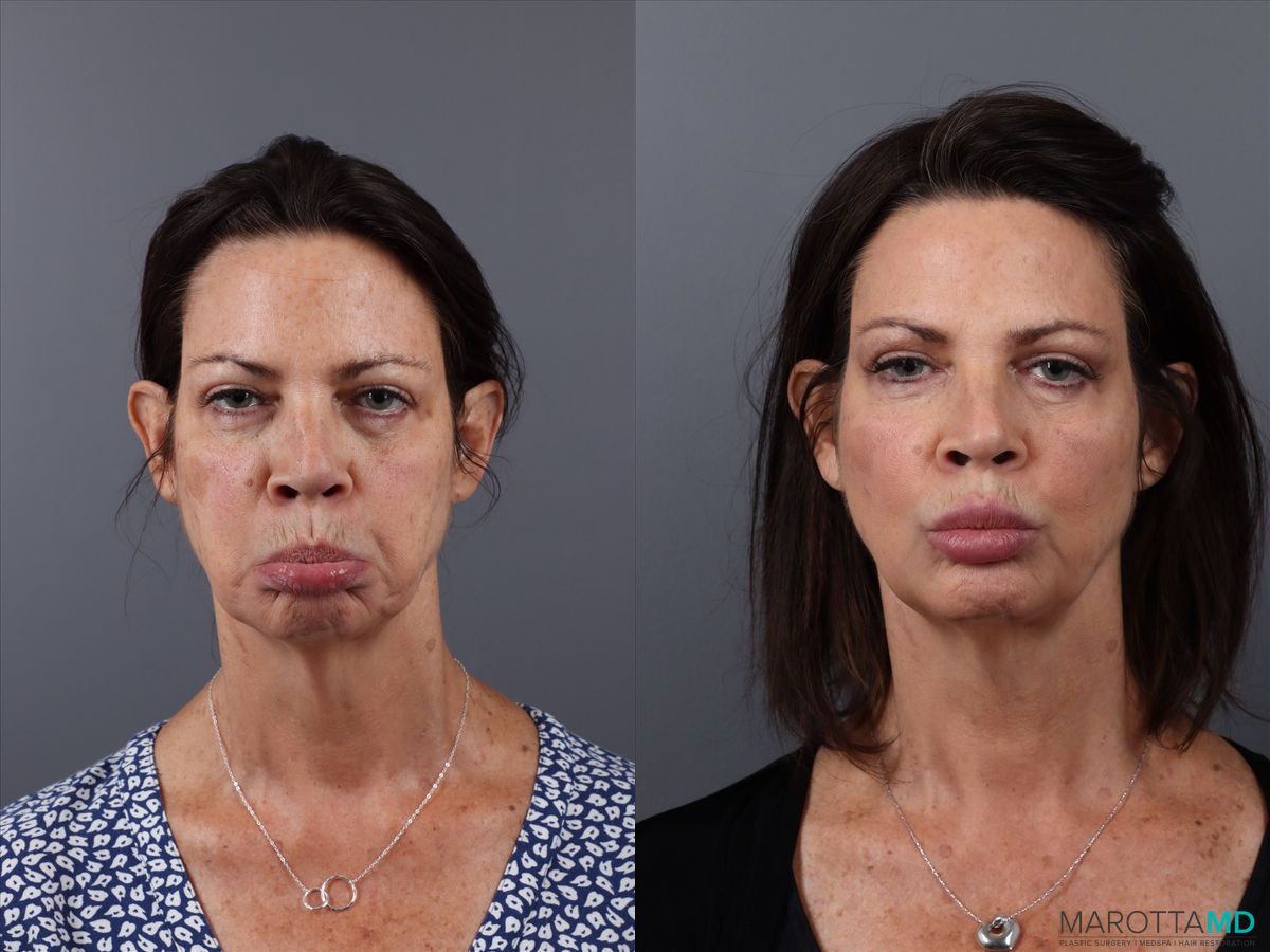 Before and after Botox - DAO case 21525 - Angle 4