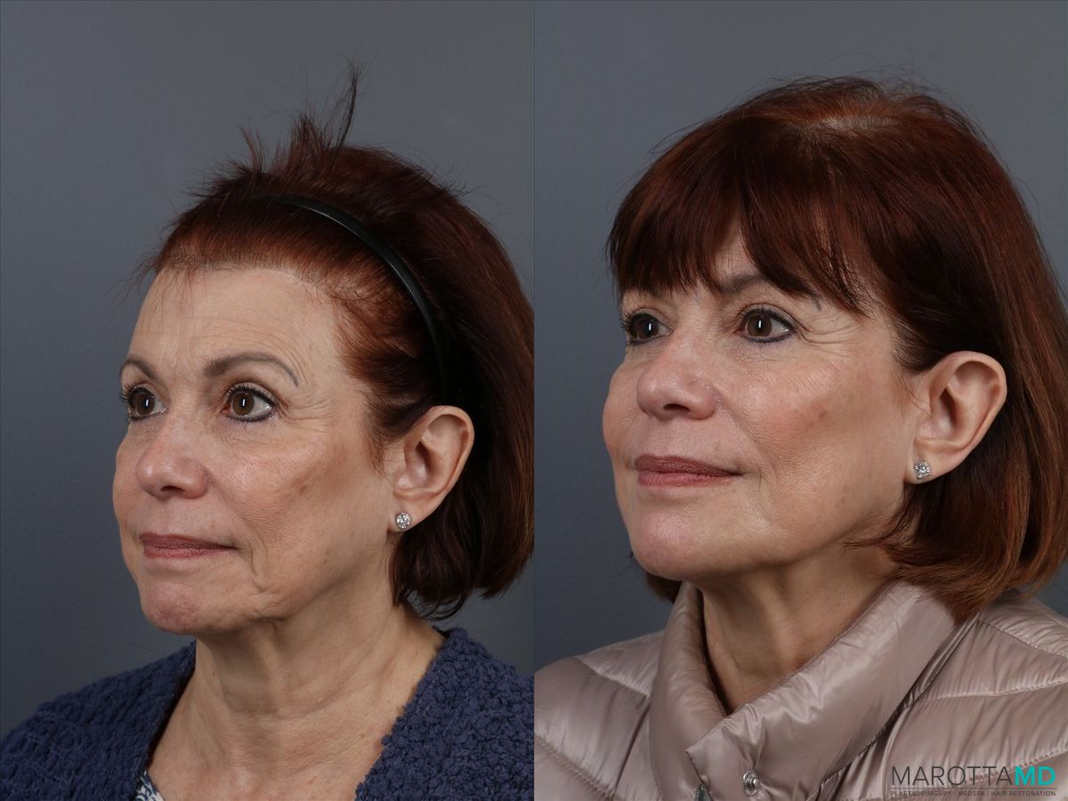 Before and after Filler - Cheek case 7316 - Angle 5
