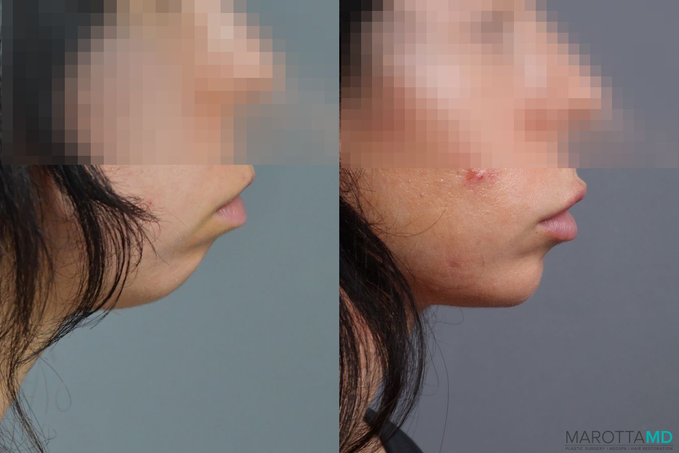 Before and after Filler - Chin case 7276 - Angle 2