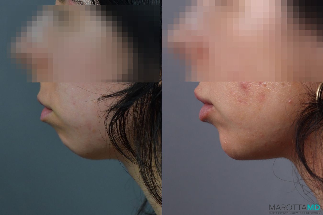 Before and after Filler - Chin case 7276