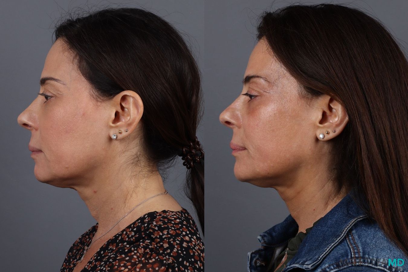 Before and after Filler - Chin case 7291 - Angle 4