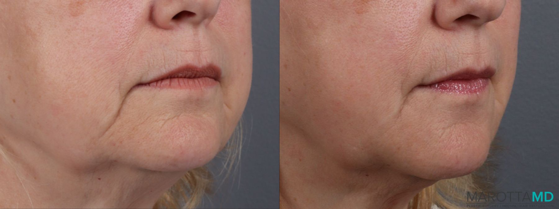 Before and after Filler - Chin Shadow case 14122 - Angle 2