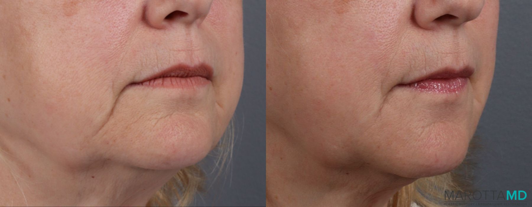 Filler - Marionette Lines - Thumbnail 2