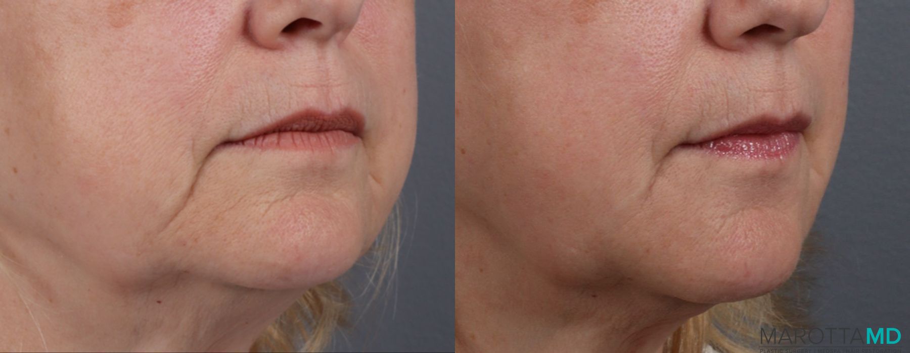 Filler - Chin Shadow - Thumbnail 3