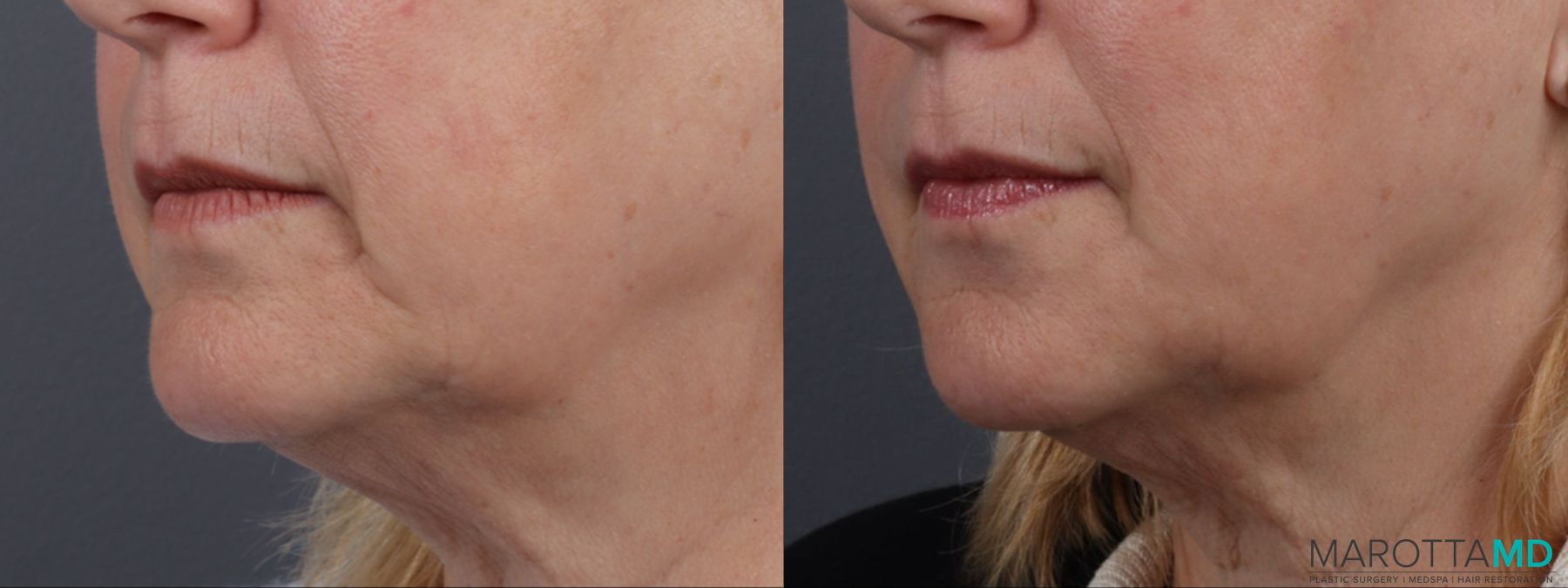 Before and after Filler - Chin Shadow case 14122 - Angle 3