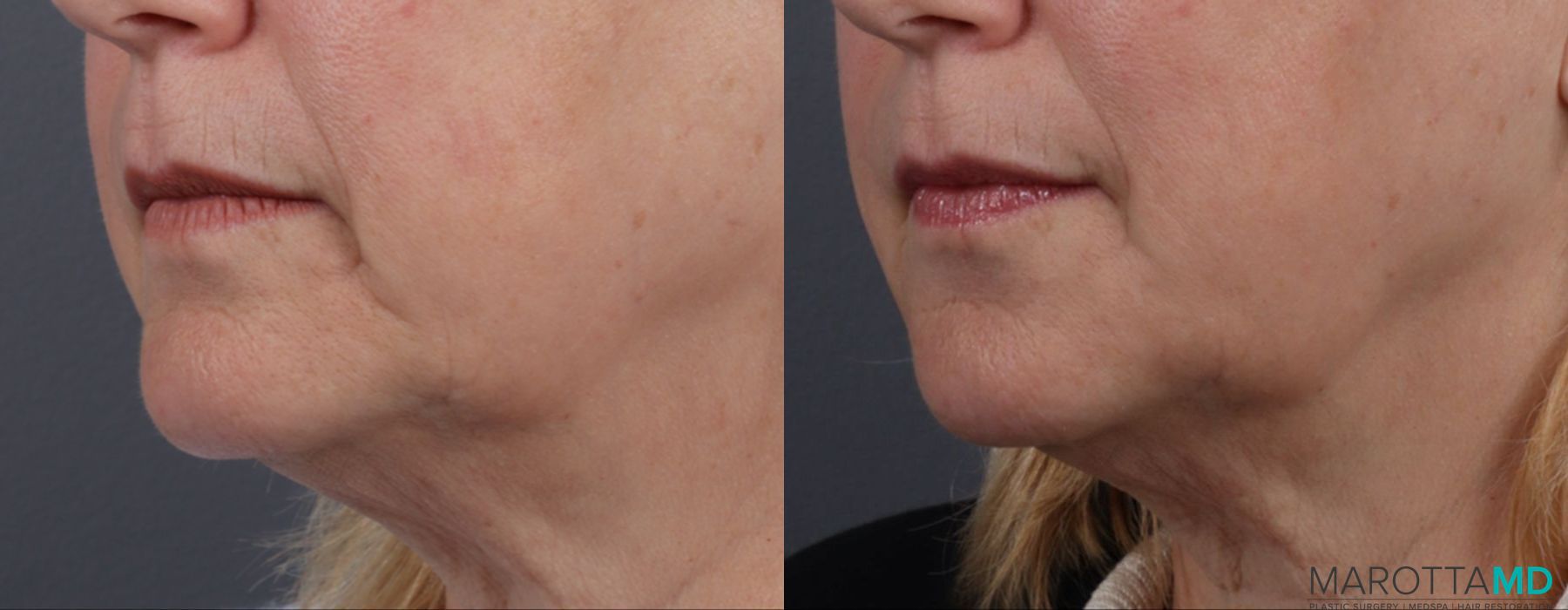 Filler - Chin Shadow - Case 779