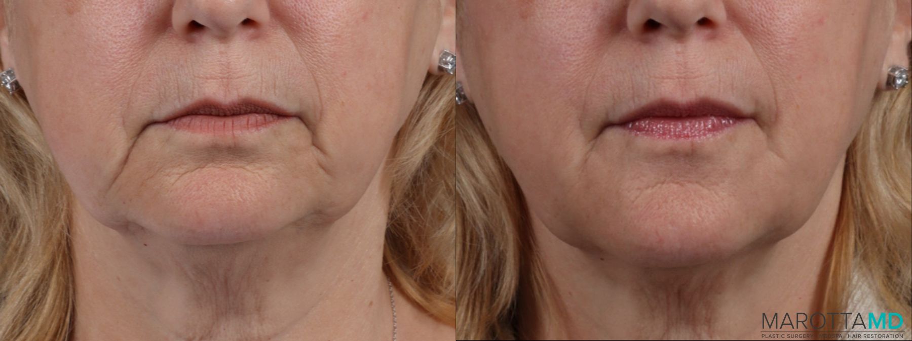 Before and after Filler - Chin Shadow case 14122