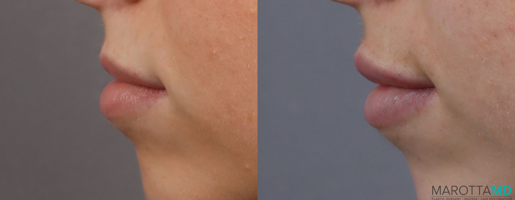 Filler - Lips - Thumbnail 3