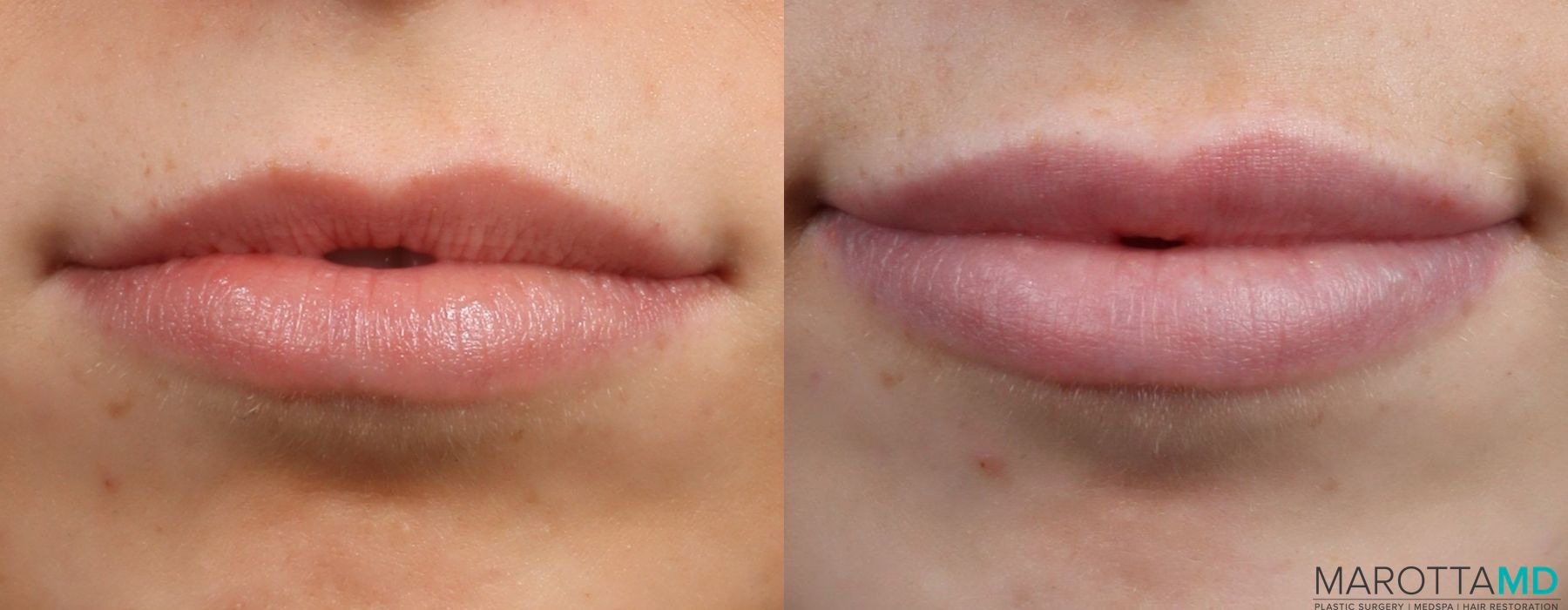 Filler - Lips - Case 397