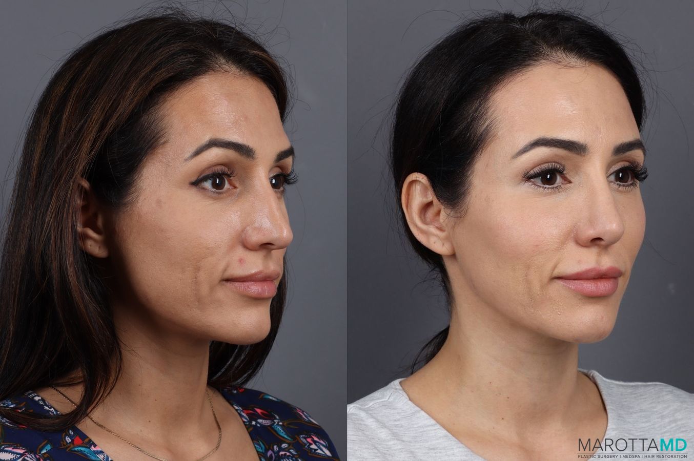 Before and after Filler - Lips case 7297 - Angle 2