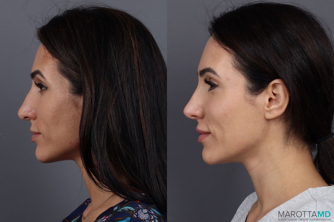 Before and after Filler - Lips case 7297 - Angle 5