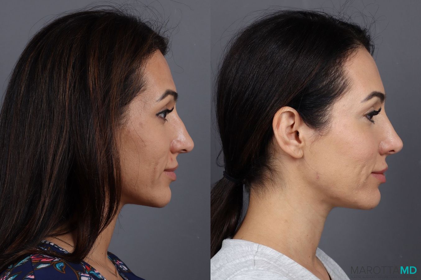 Before and after Filler - Temples case 7288 - Angle 3