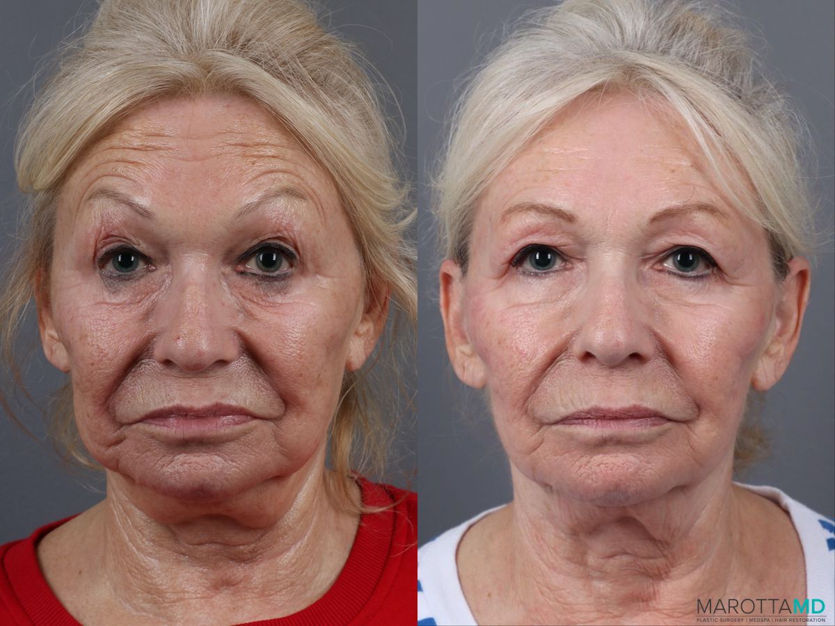 Before and after Genius Radio Frequency Microneedling case 16823 - Angle 5