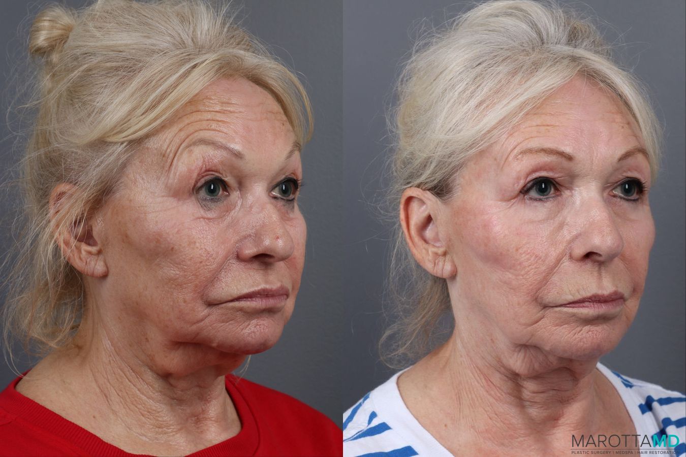 Before and after Genius Radio Frequency Microneedling case 16823