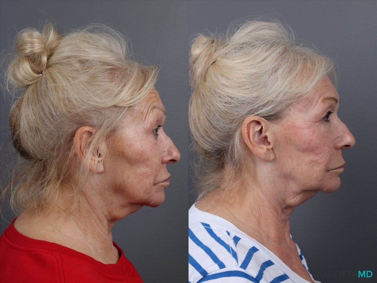 Before and after Genius Radio Frequency Microneedling case 16823 - Angle 4