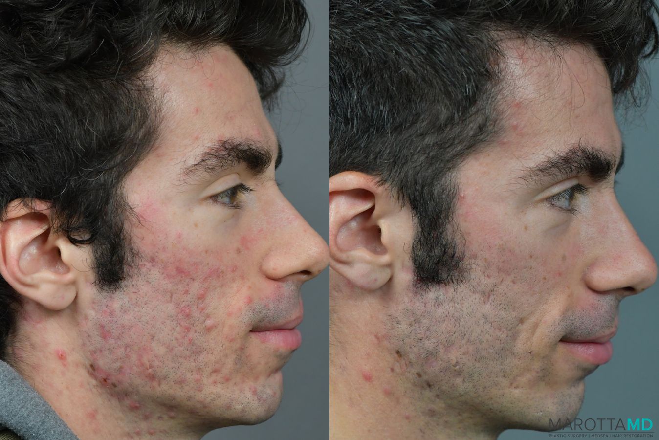 Before and after Genius Radio Frequency Microneedling case 7238 - Angle 2
