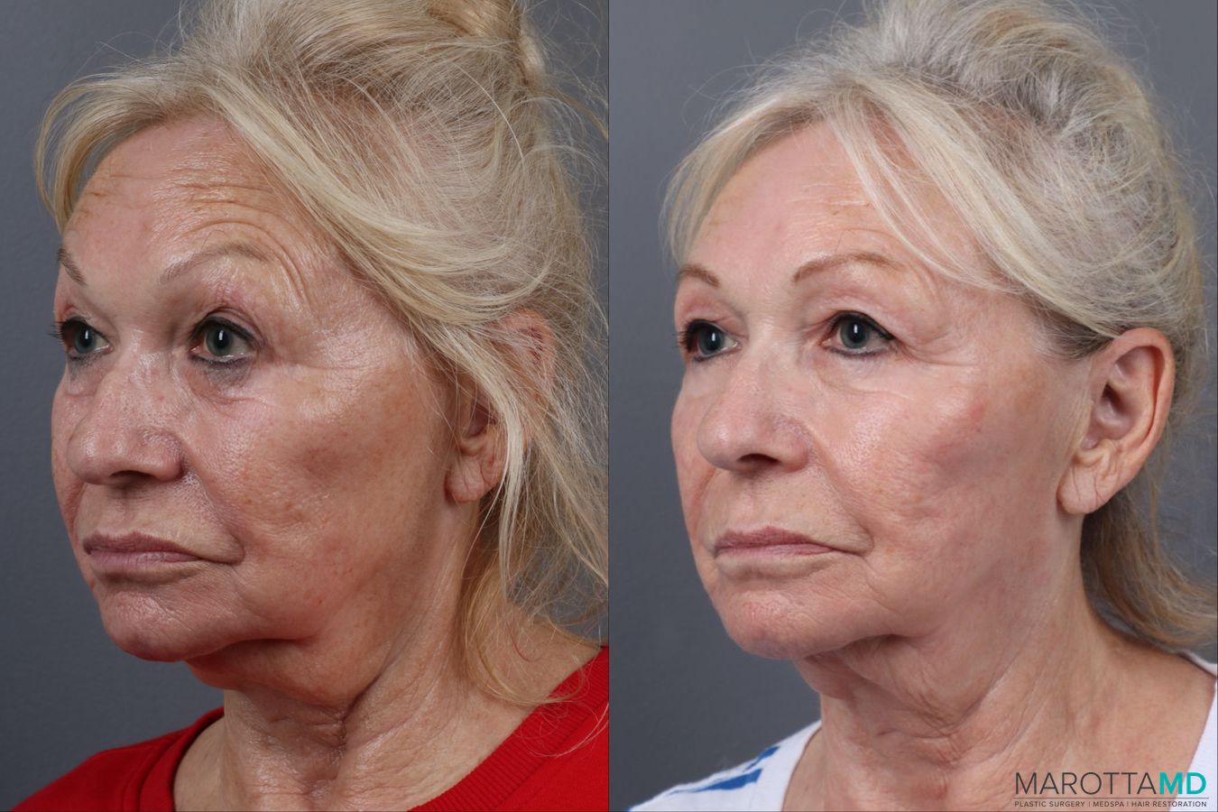 Before and after Genius Radio Frequency Microneedling case 16823 - Angle 2