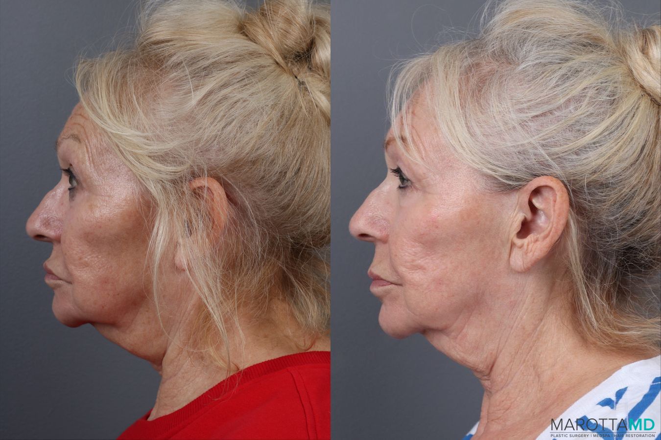 Before and after Genius Radio Frequency Microneedling case 16823 - Angle 3